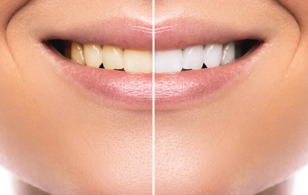 blanchiment-dentaire-pernes-les-fontaines Blanchiment dentaire : comment conserver les résultats du traitement ? Dentistes à Pernes-les-Fontaines | Pôle 158