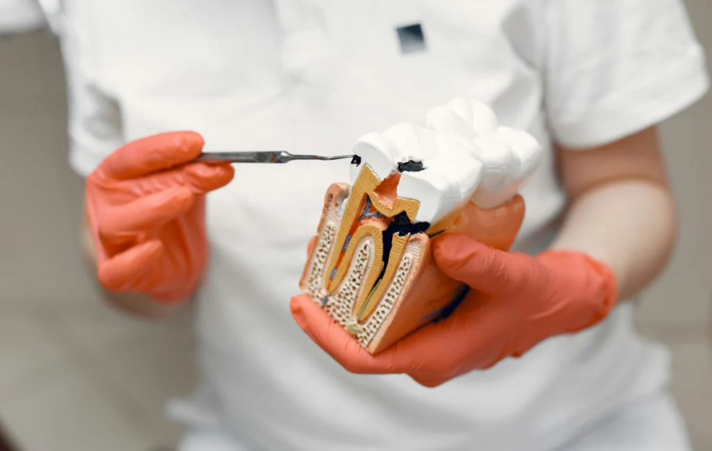 caries-dentiste-pernes-les-fontaines Inlay Dentistes à Pernes-les-Fontaines | Pôle 158