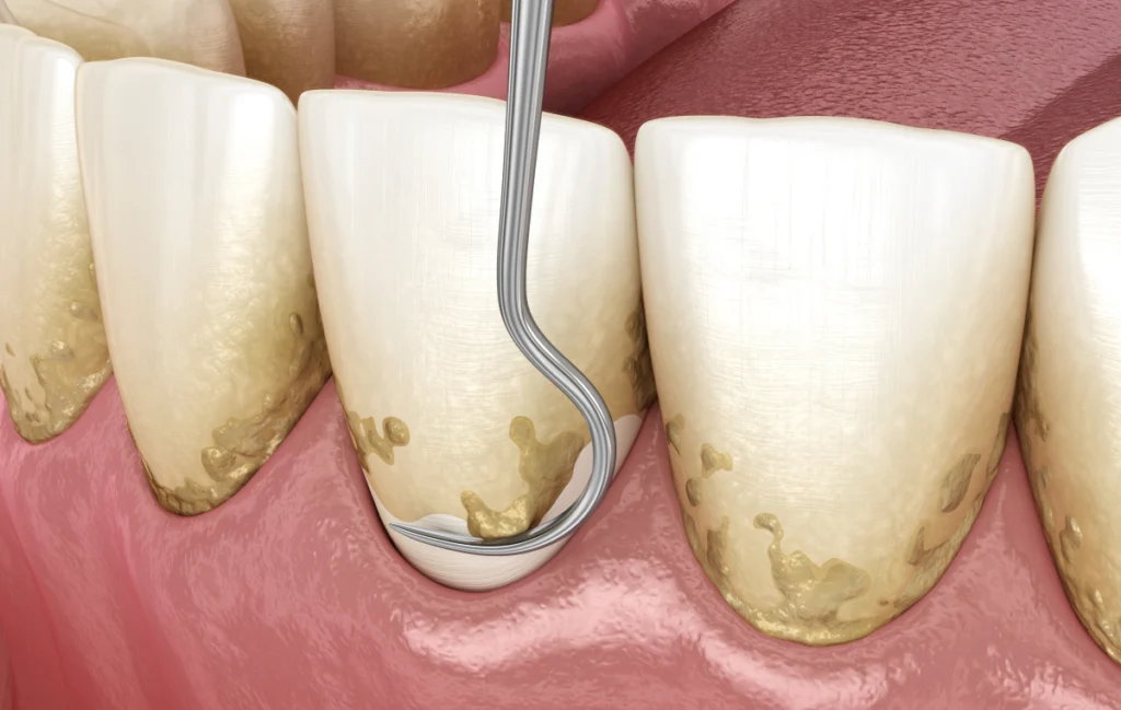 detartrage-dentistes-pernes-les-fontaines Conseils pré-opératoires Dentistes à Pernes-les-Fontaines | Pôle 158