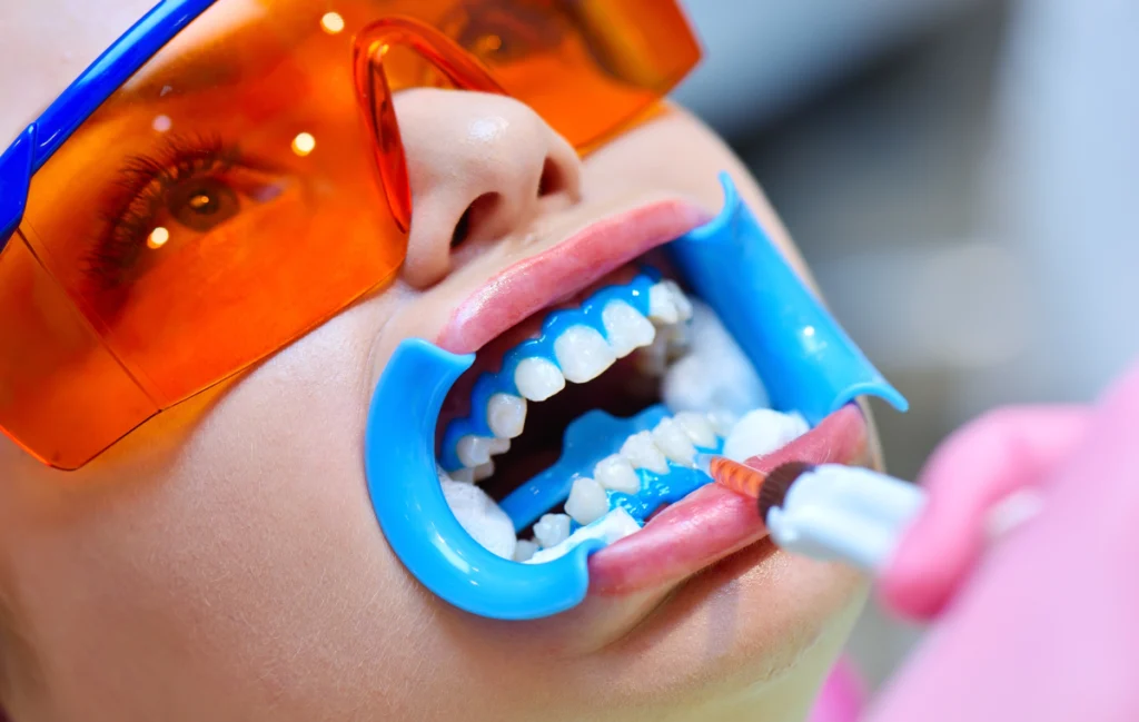 eclaircissement-dentiste-pernes-les-fontaines Blanchiment dentaire : comment conserver les résultats du traitement ? Dentistes à Pernes-les-Fontaines | Pôle 158