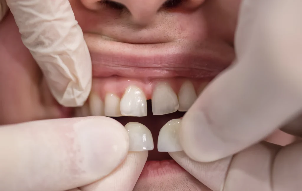 facettes-ceramiques-dentiste-pernes-les-fontaines Facettes Dentistes à Pernes-les-Fontaines | Pôle 158