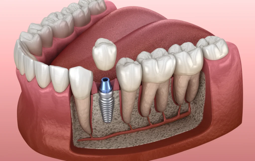 implant-dentaire-chirurgien-dentiste-pernes-les-fontaines implant-dentaire-chirurgien-dentiste-pernes-les-fontaines Implant dentaire Dentistes à Pernes-les-Fontaines | Pôle 158