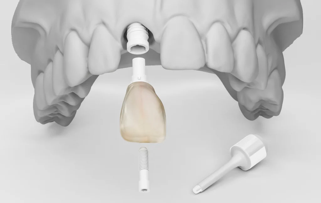 implant-dentaire-dentiste-pernes-les-fontaines implant-dentaire-dentiste-pernes-les-fontaines Implant dentaire Dentistes à Pernes-les-Fontaines | Pôle 158