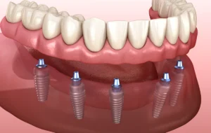 Prothèse complète sur implant