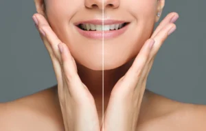 Blanchiment dentaire