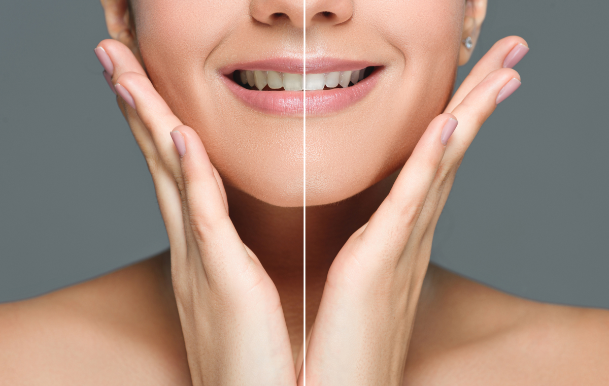 blanchiment-dentistaire-pernes-les-fontaines Blanchiment dentaire Dentistes à Pernes-les-Fontaines | Pôle 158