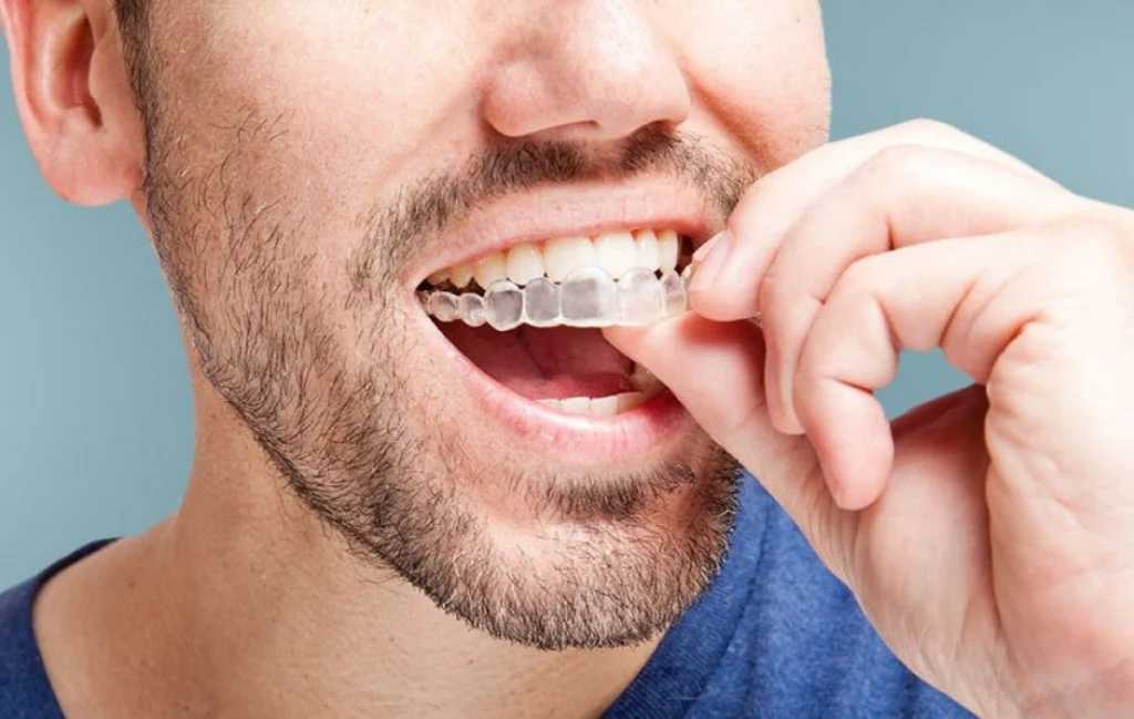 invisalign-dentiste-pernes-les-fontaines Orthodontie Dentistes à Pernes-les-Fontaines | Pôle 158